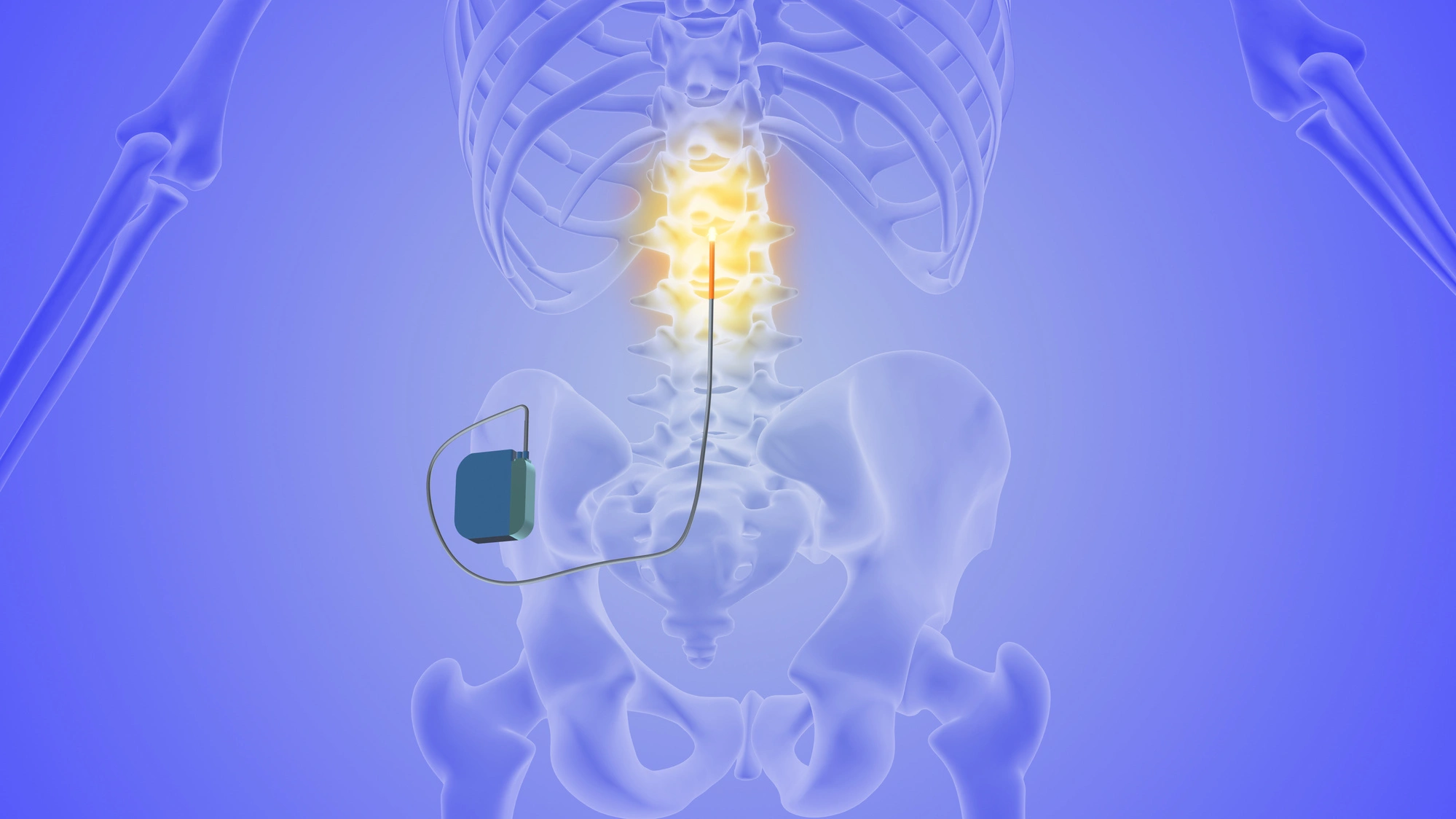 Spinal Cord Stimulator in Sandy and Bountiful, Utah, at Alta Pain Physicians