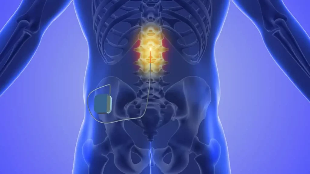 Spinal Cord Stimulator by Alta Pain Physicians in Sandy UT