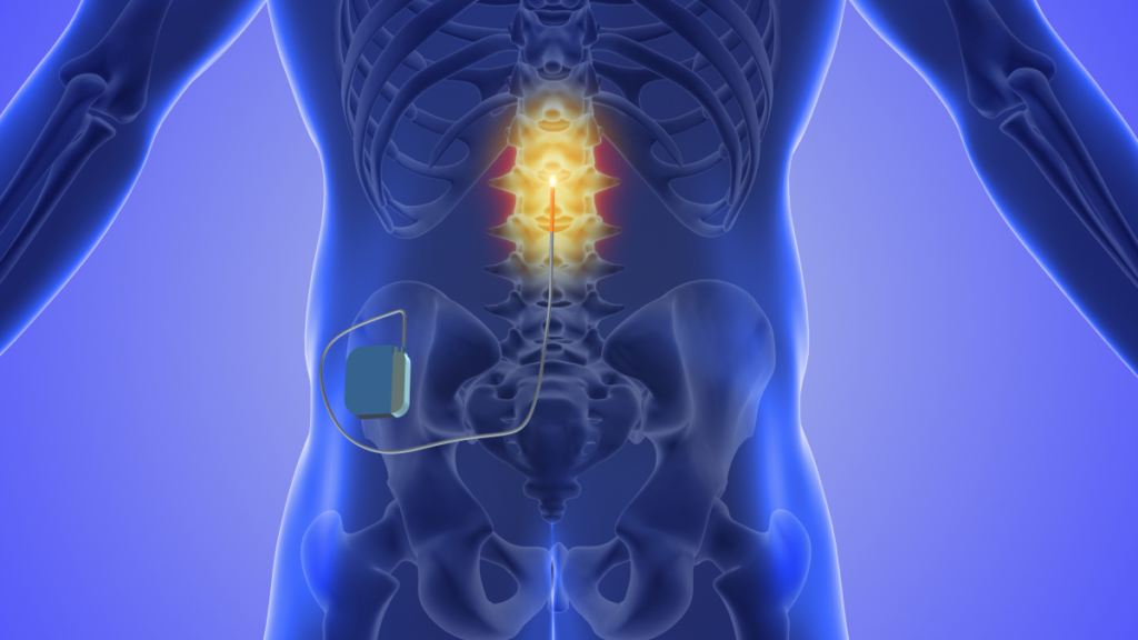 Spinal Cord Stimulator in Bountiful and Sandy, Utah, at Alta Pain Physicians