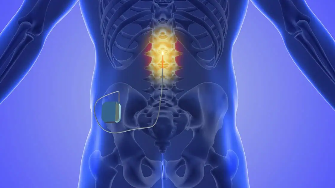 Spinal Cord Stimulator in Bountiful, UT by Alta Pain Physicians