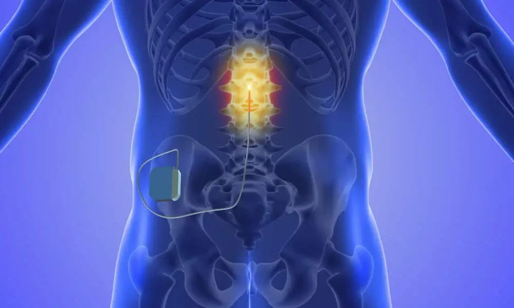 Spinal Cord Stimulator by Alta Pain Physicians in Sandy UT