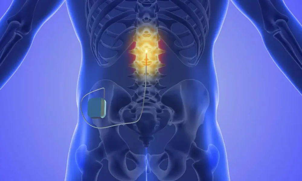 Spinal Cord Stimulator in Bountiful, UT by Alta Pain Physicians